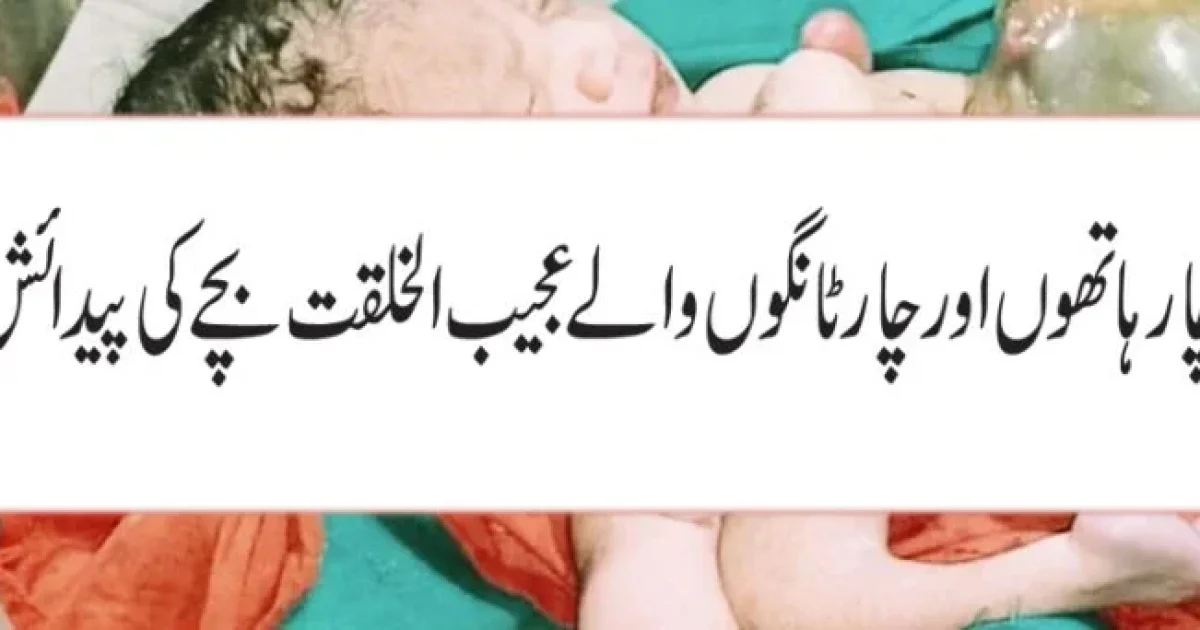 چار ہاتھوں اور چار ٹانگوں والے بچے کی پیدائش، دیکھنے کے لیے عوام امڈ آئے